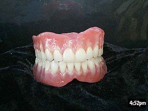 Custom stained upper and lower denture