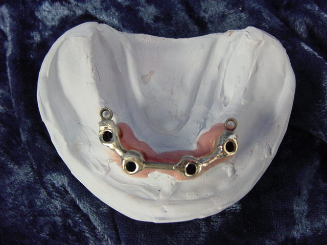 combination hader with era in type IV gold over 4 3i implants